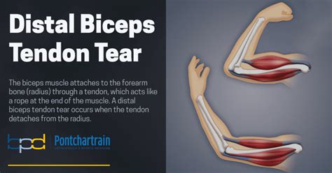 biceps brachii tear test|distal biceps tear treatment.